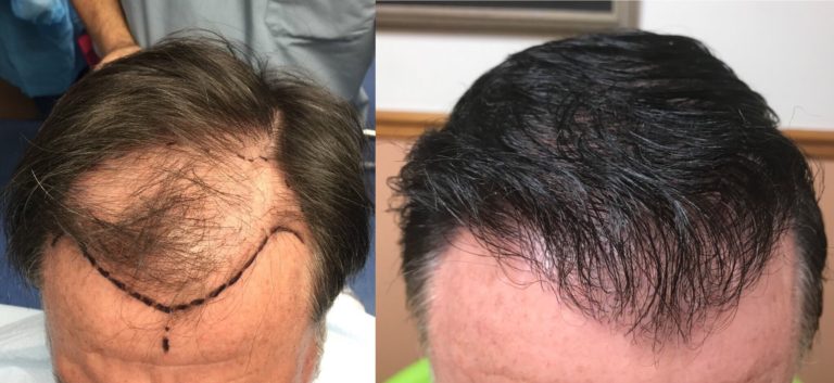 کاشت موی طبیعی قبل و بعد